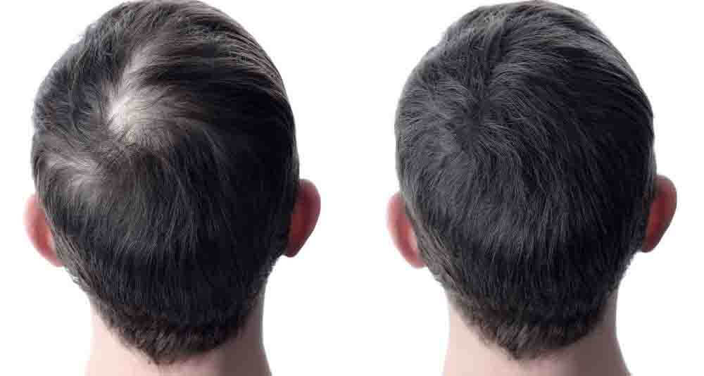 homme cheveux clairsemés vs cheveux touffus